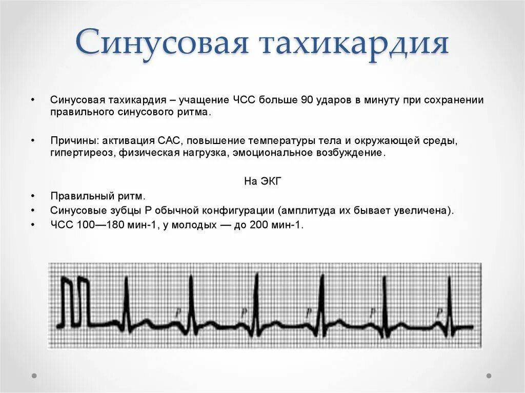 Тахикардия сколько ударов в минуту. Экг при синусовой тахикардии сердца. синусовая тахиаритмия на экг. синусовая тахикардия экг признаки. клинические симптомы тахикардии.