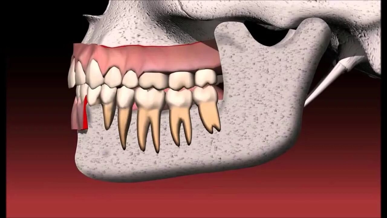 Two tooths. Dental Bridge. Bridge in Dentistry.