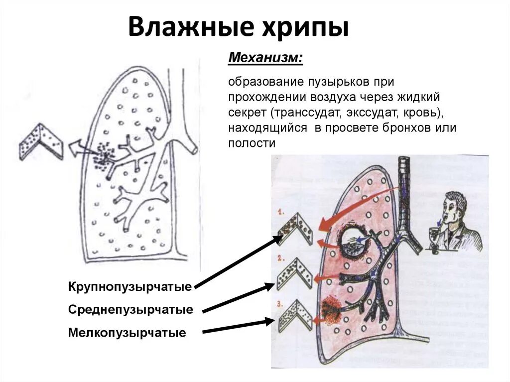 Звуки бронхита. Механизмы образования сухих и влажных хрипов схема. Механизм образования сухих хрипов схема. Механизм образования мелкопузырчатых хрипов. Схема возникновения хрипов.