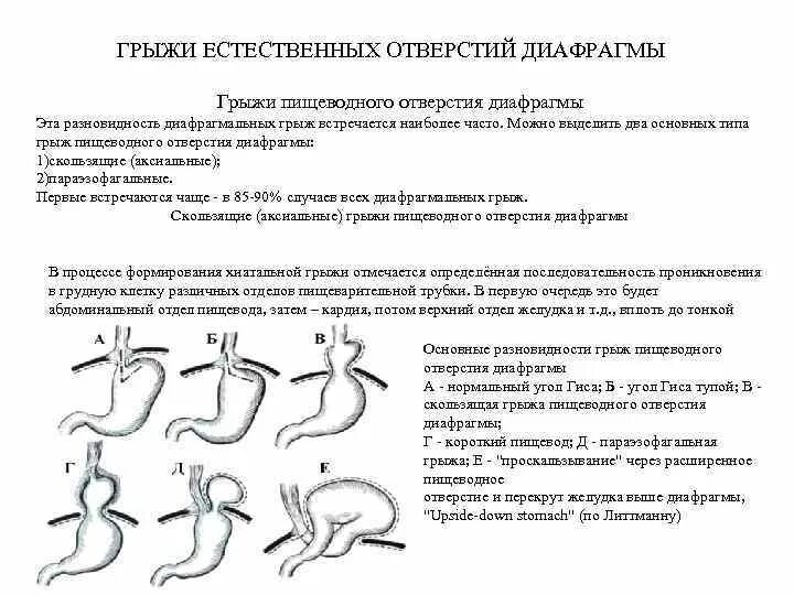 Кардиальная грыжа под. Степени грыжи пищеводного отверстия диафрагмы классификация. Эндоскопическая классификация грыж пищеводного отверстия диафрагмы. Грыжа пищеводного отверстия диафрагмы 1 степени. ГПОД аксиальная скользящая.