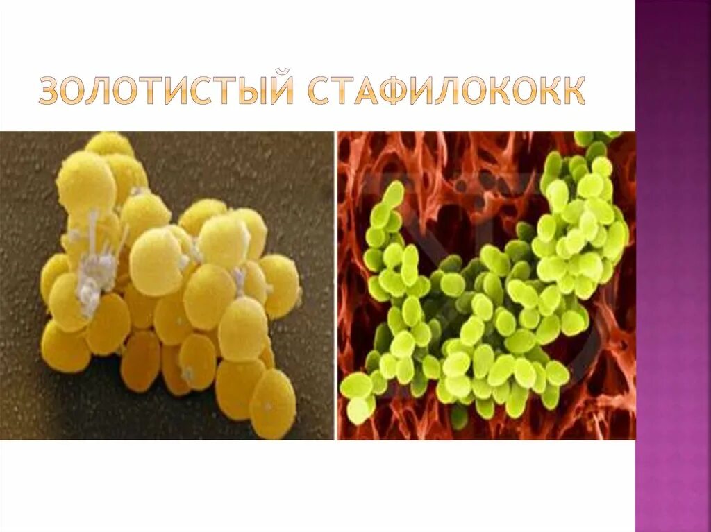 Staphylococcus aureus 10 5. Инфекция золотистый стафилококк. Псевдофурункулез (множественные абсцессы кожи).