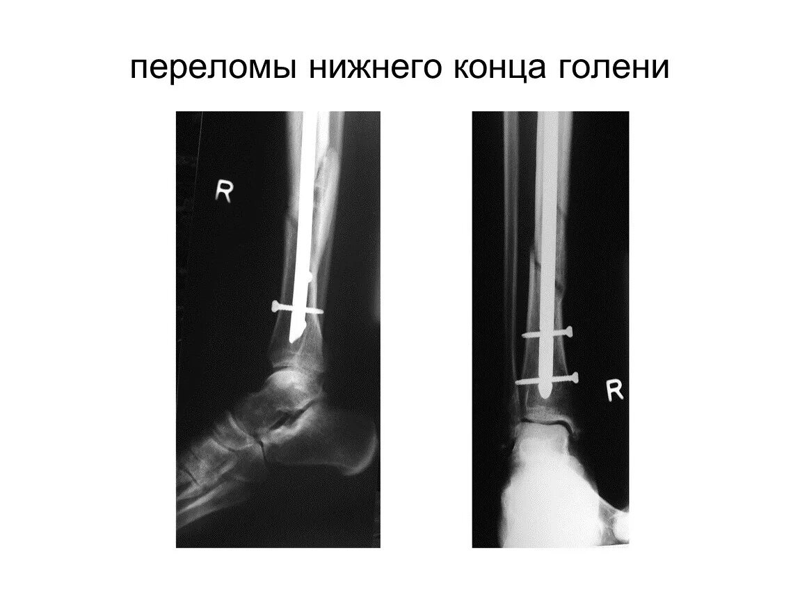 Двухлодыжечный перелом голени. Закрытый перелом нижней трети голени. Множественные переломы голени. Открытый перелом нижней трети голени.