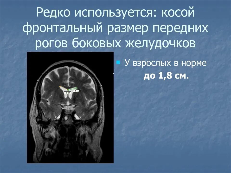 Расширение боковых рогов