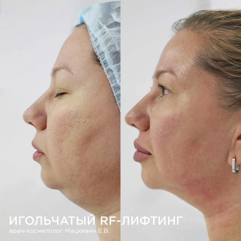 Игольчатый rf недорого skinlift ru. Микроигольчатый RF-лифтинг. Микроигольчатый RF-лифтинг рубцы. Игольчатый RF лифтинг Морфеус 8.