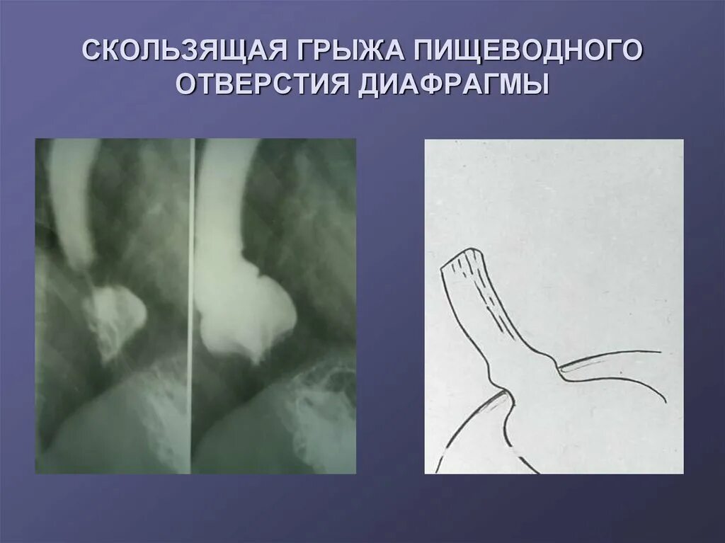 Аксиальная скользящая грыжа рентген. Скользящие и параэзофагеальные грыжи пищеводного отверстия. Аксиальная хиатальная грыжа рентген. Скользящая аксиальная грыжа пищеводного отверстия 2 степени.