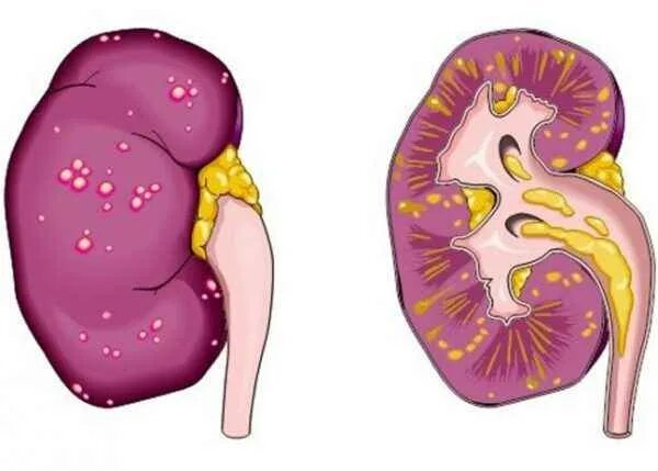Признаки пиелонефрита почек. Хронический пиелонефрит почек. Пиелонефрит почек у мужчин. Острый пиелонефрит симптомы у мужчин. Левосторонний пиелонефрит.
