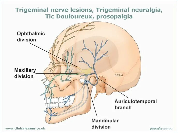 Neuralgia латынь. Тройничный нерв неврология. trigeminal neuralgia. менингиома тройничного нерва.