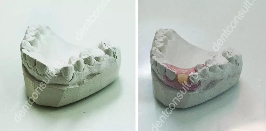 Микропротез бабочка на 1 зуб. Иммедиат протезы ортопедическая стоматология. Иммедиат протез на 1 зуб на верхней челюсти. Изготовление иммедиат протеза