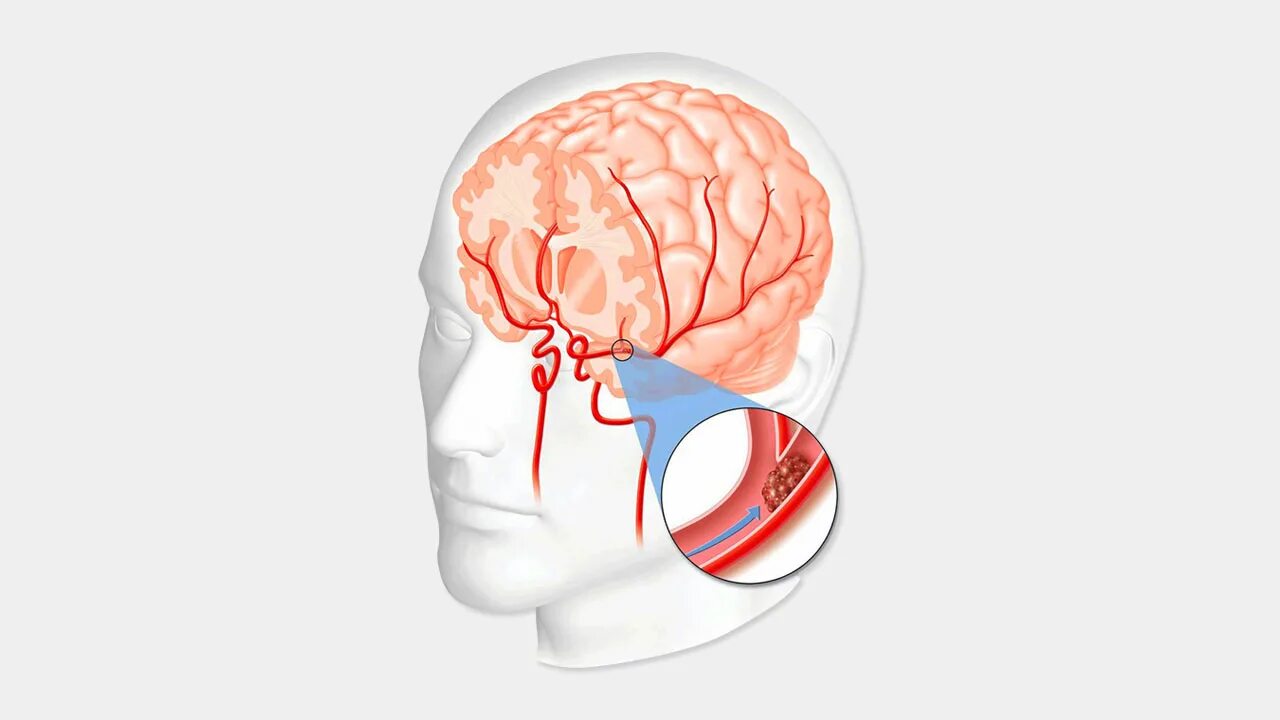 Дисциркуляторная энцефалопатия на кт. Что такое ишемический инсульт головного мозга