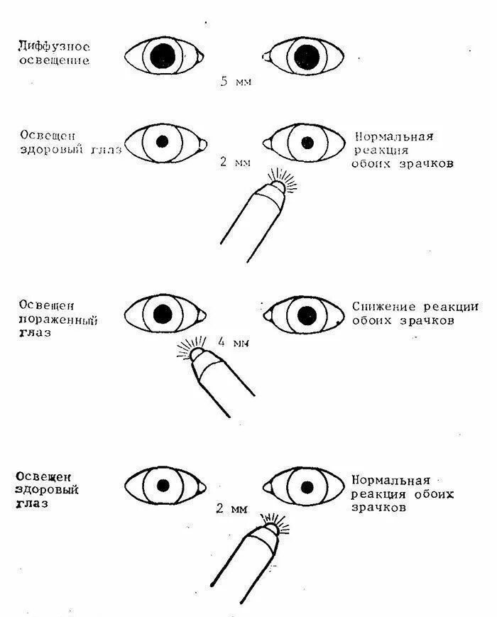 Расширенные зрачки не реагирующие на свет. Способ определения реакции зрачков на свет. Метод определения реакции зрачка на свет. Схема реакции зрачка на свет. Методика реакции зрачка на свет.