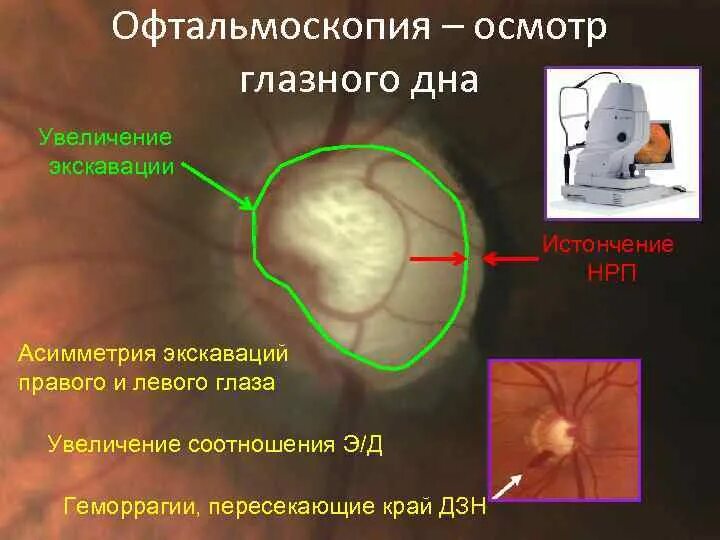 Зрительный нерв при глаукоме. Глаукоматозная экскавация диска зрительного нерва. Офтальмоскопия диска зрительного нерва. Экскавация зрительного нерва норма.