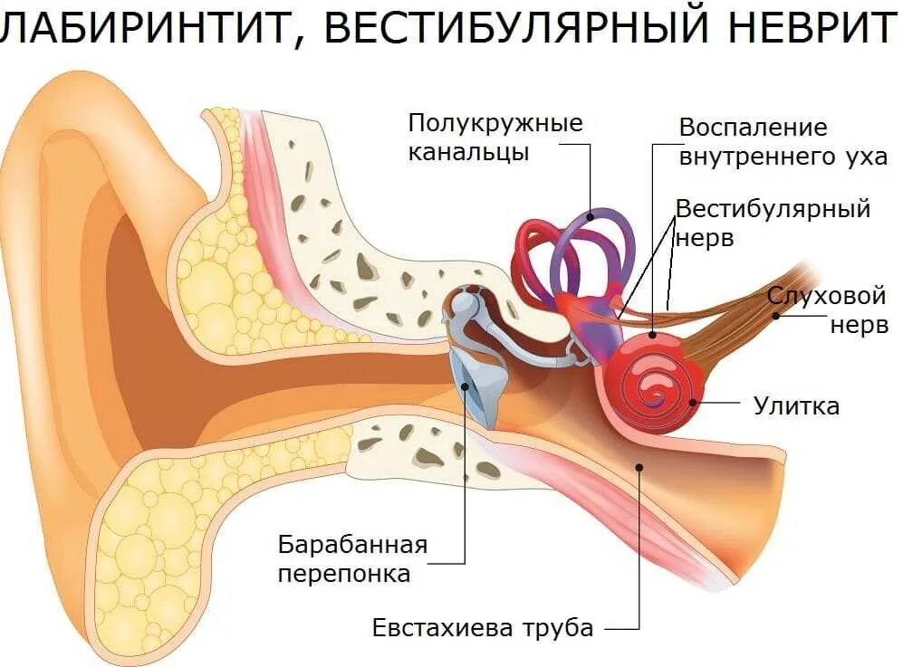 Внутреннее ухо лечение и симптомы. Воспаление внутреннего уха (лабиринтит) возникает. Тимпаногенный лабиринтит. Воспаление внутреннего уха лабиринтит. Внутренний отит (лабиринтит).