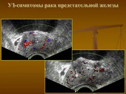 Что такое онкология предстательной железы