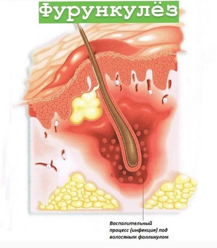 Почему постоянно воспаляется. Фурункулез волосяных фолликулов. Фурункулез некротический стержень.