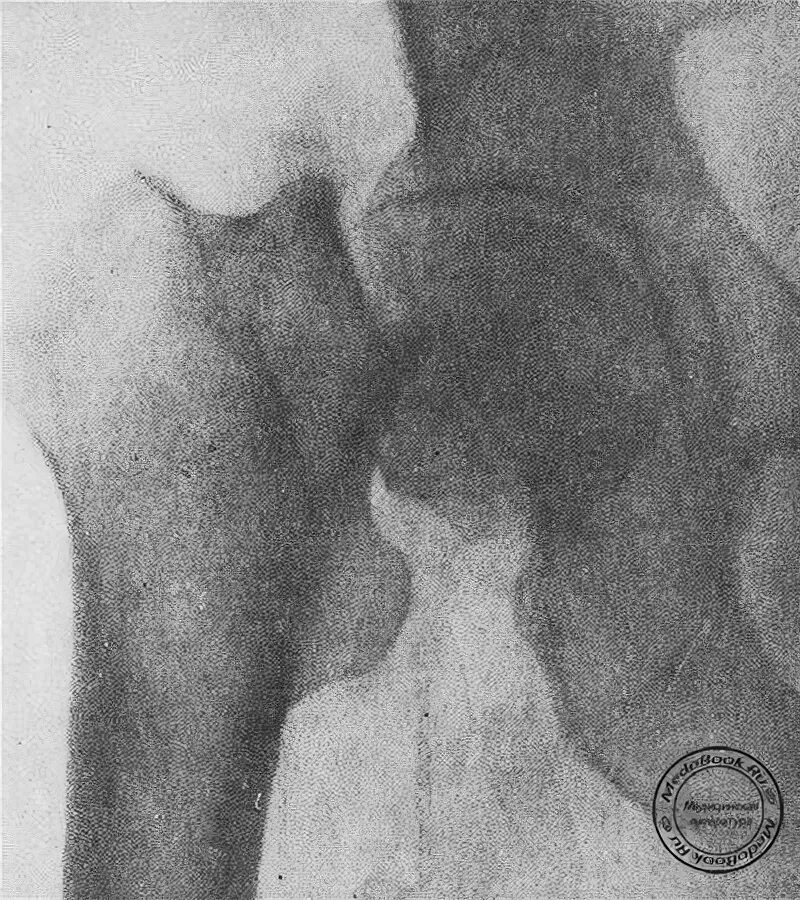 абдукционный и аддукционный перелом шейки бедра. аддукционные переломы шейки бедра. субкапитальный перелом левой бедренной кости. субкапитальный перелом бедренной кости со смещением отломков. перелом шейки бедра формулировка диагноза.