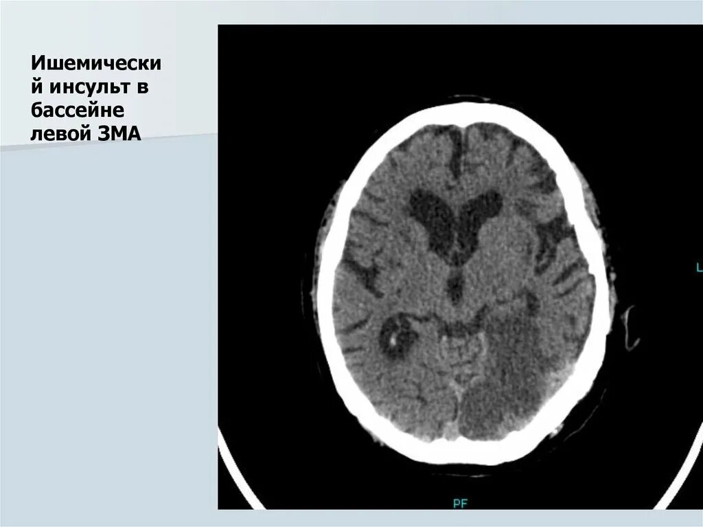 Мрт ишемический инсульт в бассейне левой средней мозговой артерии. Ишемический инфаркт на кт. Ишемический инсульт мозга на кт. Ишемический инсульт на кт головного мозга.