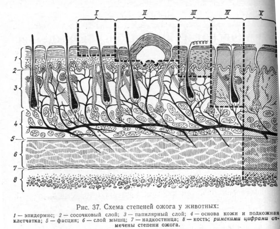 Классификация ожогов по глубине. Классификация ожогов по степени глубины.