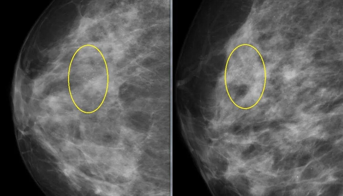 Округлые кальцинаты. Маммография микрокальцинаты. Маммография раковые микрокальцинаты. РМЖ кальцинаты маммограмма.