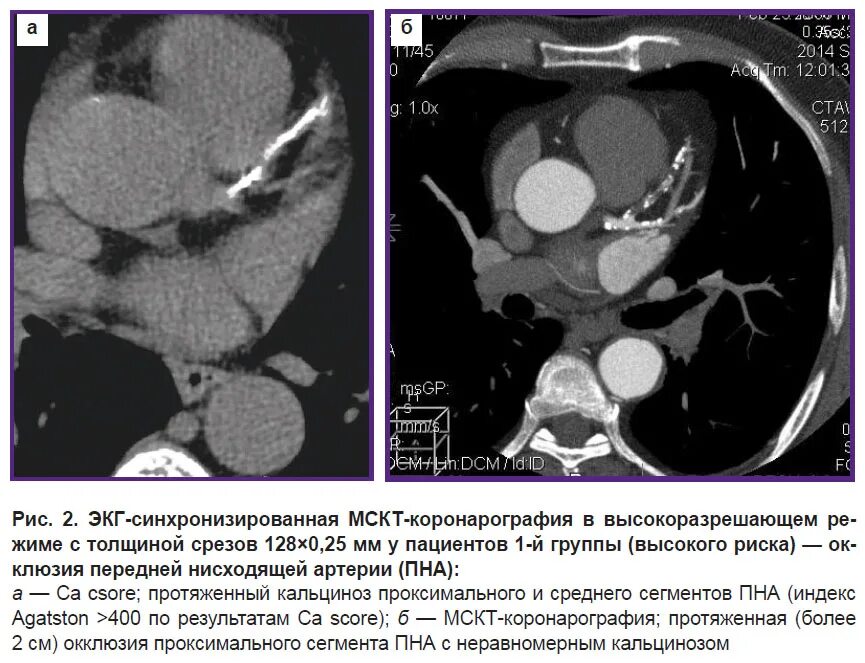 128 срезов. Кальциноз коронарных артерий на кт. Кальциноз коронарных сосудов кт. Кт коронароангиография. Кт-ангиография коронарных артерий.