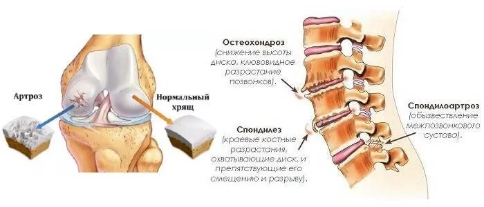 Коллаген для хрящей и суставов. Коллагеновые уколы для суставов. Коллаген для суставов уколы. Уколы коллагена в коленный сустав. Коллаген уколы для суставов