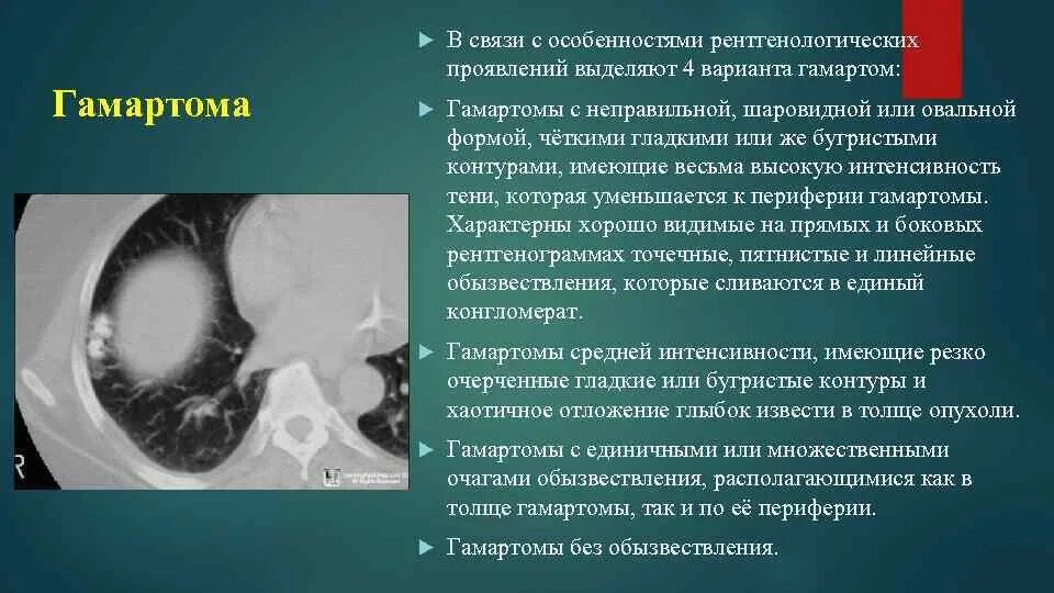 Гамартома правого легкого рентген. Гамартома рентген признаки. Гамартохондрома легких кт. Гамартома это. Гамартома легкого на кт.