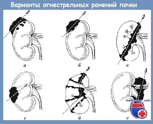 Стадия удаление почки 3. Классификация огнестрельных ранений. огнестрельное ранение почки. слепое огнестрельное ранение.