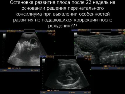 Перинатальное развитие плода