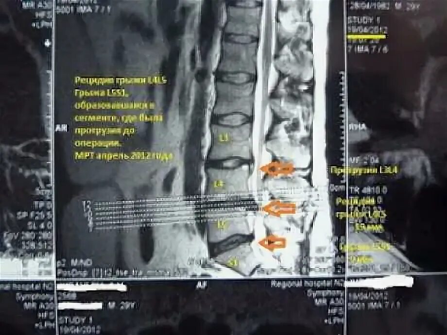 Болит нога после операции грыжи позвоночника. Размеры межпозвоночной грыжи. Рецидив грыжи позвоночника. Рецидив грыжи межпозвоночного диска.