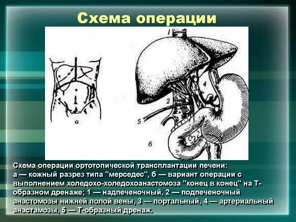 Пдр операция. Ортотопической трансплантации печени. Трансплантация печени операция. Операция транспортации печени.