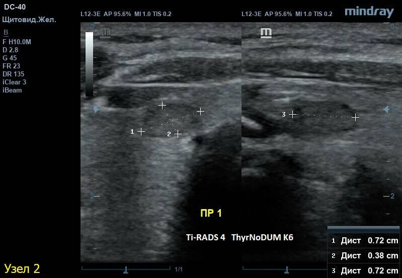 УЗИ щитовидной железы микрокальцинаты. Микрокальцинаты узла щитовидной железы на УЗИ. Микрокальцинаты в щитовидной железе на УЗИ. УЗИ щитовидной железы узел правой доли. Щитовидная железа узи лимфоузлы