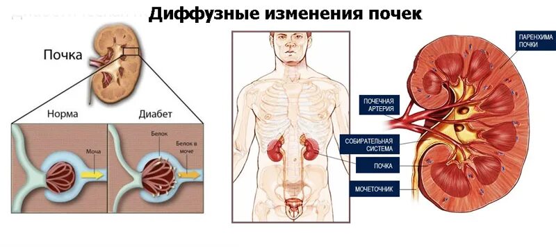 Изменение синусов обеих почек