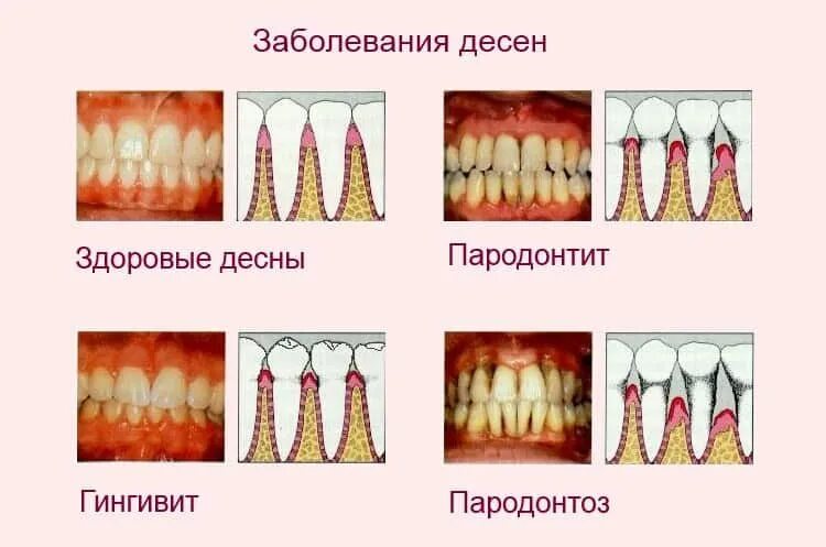 Классификация поражений зубов