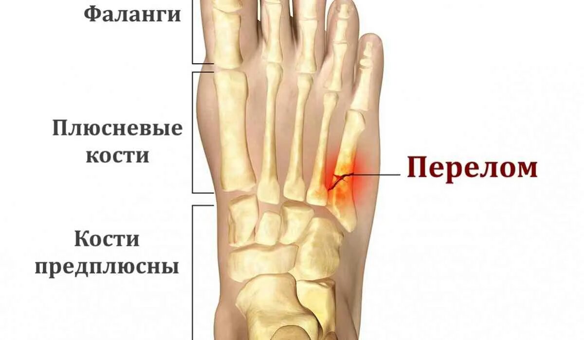 Мкб 10 плюсневая кость. Перелом 1 плюсневой кости. 5 Плюсневая кость стопы. Стресс перелом плюсневой кости стопы. Костная мозоль плюсневой кости.