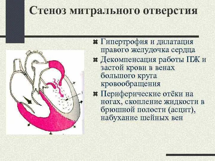 Гипертрофия полостей сердца. Пороки сердца митральный стеноз схема. стеноз митрального клапана гемодинамика схема. гипертрофия правого желудочка при митральной недостаточности.