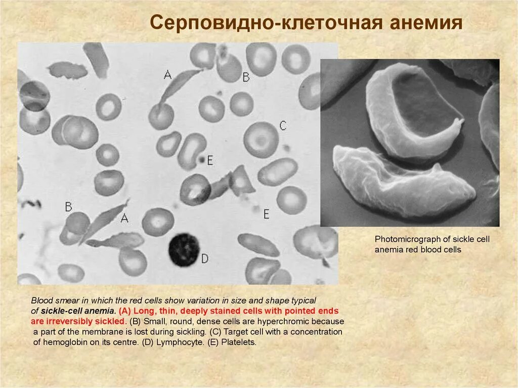 Эритроциты при серповидно клеточной анемии. Задача на серповидно клеточную анемию. Серповидноклеточная анемия задачи. Серповилно клетосная анемия в задачах. Серповидноклеточная анемия мутация.