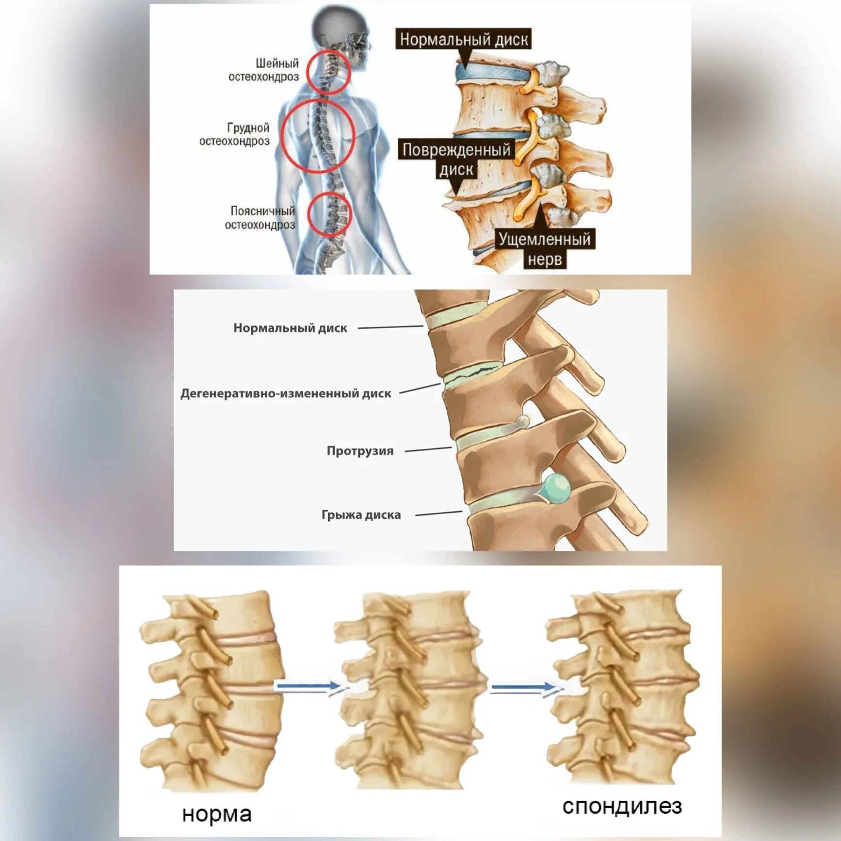 Спондилёз поясничного отдела позвоночника что это такое. Остеохондроз спондилез спондилоартроз. Грыжа позвоночника остеохондроз спондилоартроз. Спинная грыжа.