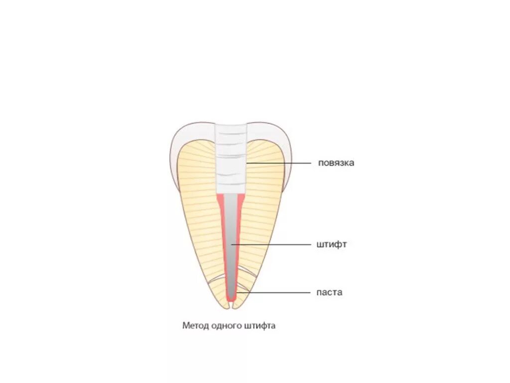 Методы пломбирования корневых. Метод одного штифта гуттаперчи. Метод одного штифта пломбирования каналов. Методика пломбирования корневых каналов. Метод одного штифта. Пломбирование методом 1 штифта.