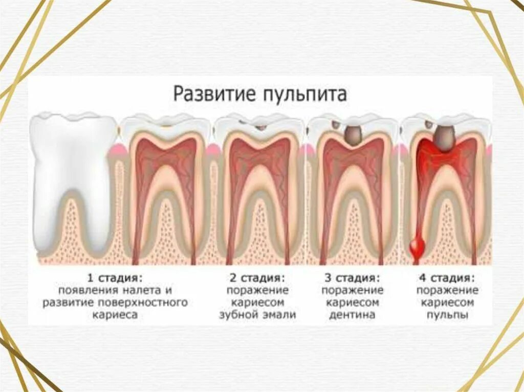 Пульпит тесты с ответами. Пульпит молочного зуба этапы. трехсторонний пульпит. пульпит на переднем молочном зубе.