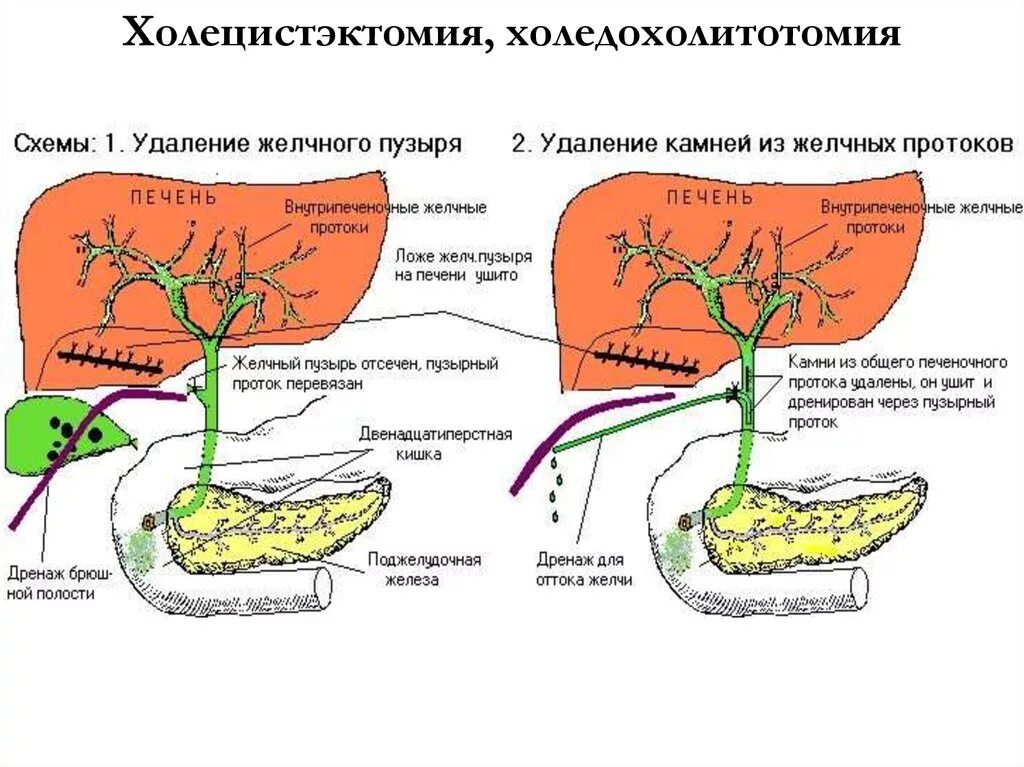 Желчный пузырь и поджелудочная железа анализы. Анатомия желчных протоков операция. Схема путей оттока желчи. Желчный пузырь схема. Операция на желчь желчный пузырь.