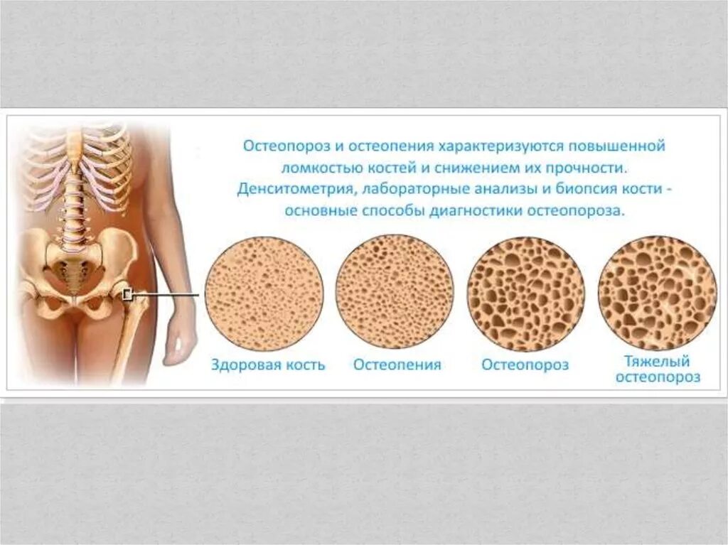 Как повысить плотность костей. Остеопороз. остеопения и остеопороз. болезнь костей остеопороз. повышенная ломкость костей.