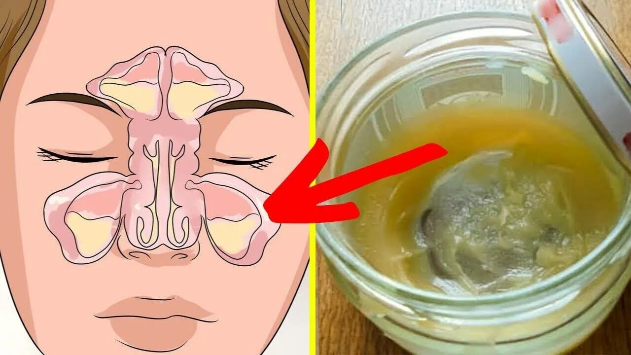 Что делать если сопли текут как вода