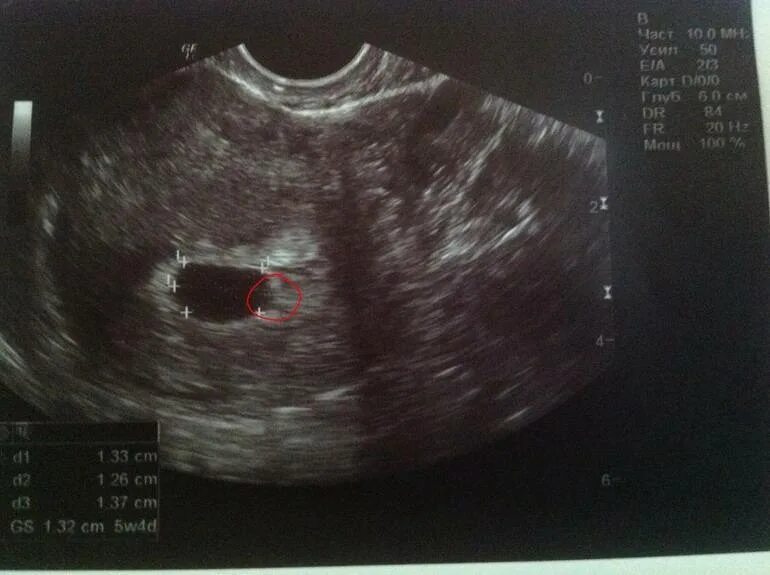 УЗИ 6 недель беременности желточный мешок. УЗИ плодное яйцо 6 недель. УЗИ 6 недель беременности плодное яйцо на УЗИ. Плодное яйцо 5 недель на УЗИ беременность 6. 45 недель было