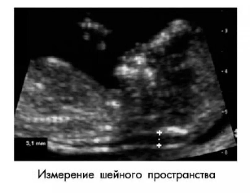 Воротниковое пространство 5. Твп 3,5. скрининг беременности толщина воротникового пространства. воротниковое пространство на 1 скрининге. узи воротниковое пространство.