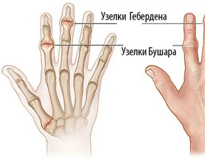 Узелки Гебердена и Бушара. Узелки Гебердена и Бушара характерны для. Суставы кисти руки. Артрит межфаланговых