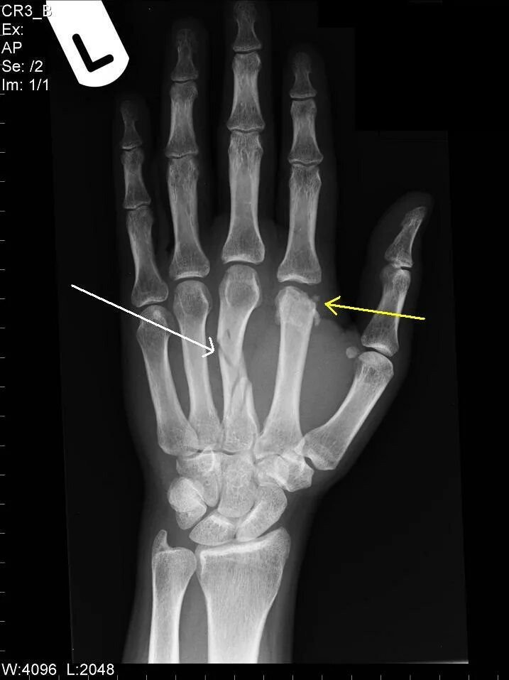 Пястная кость смещение