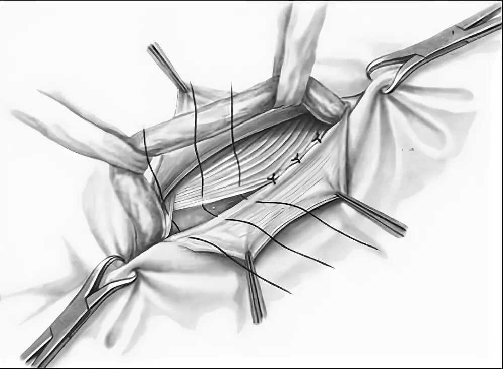 Герниопластика по Лихтенштейну паховой грыжи. Герниопластика паховой грыжи по Бассини. Грыжесечение, герниопластика по Бассини.. Лихтенштейн операция паховая