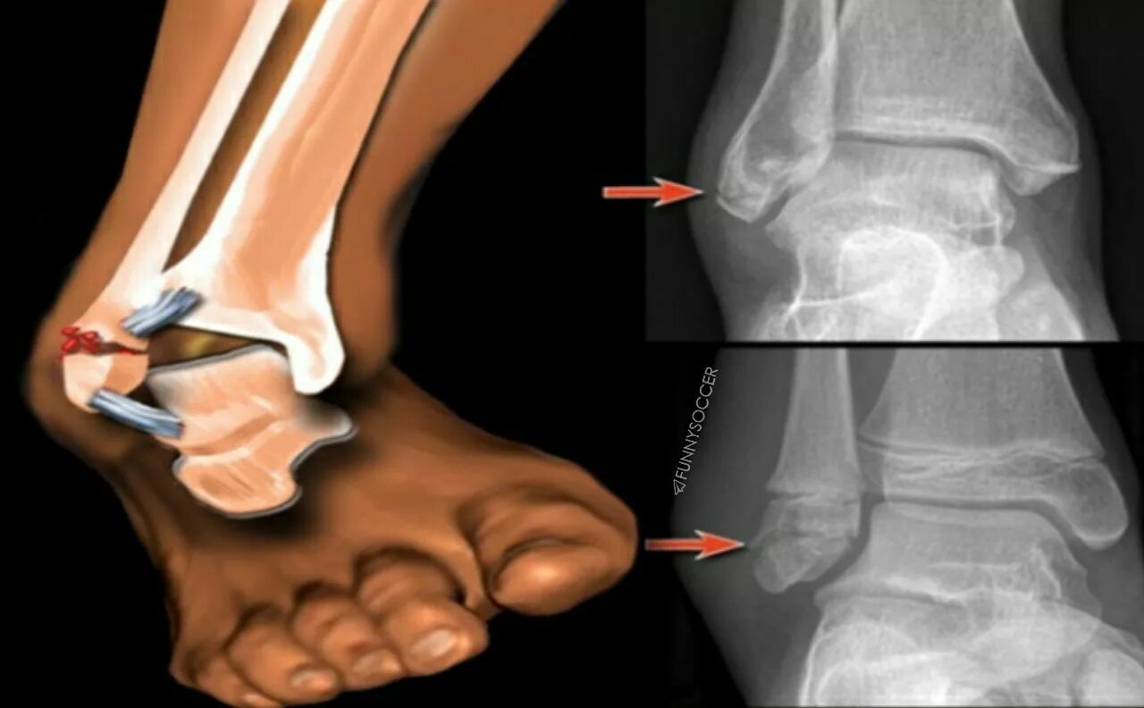 Синдесмоз голеностопного. Разрыв межберцового синдесмоза рентген. Перелом лодыжки синдесмоз. Разрыв дистального синдесмоза. Слабость голеностопного сустава