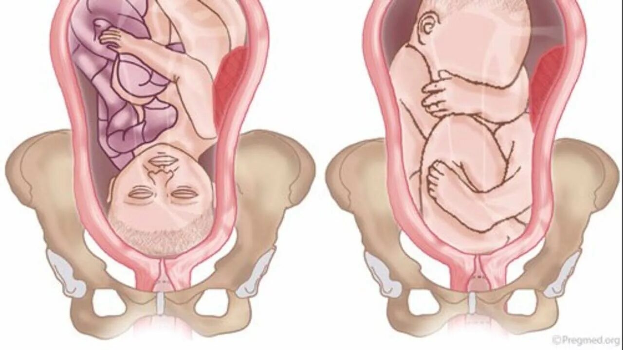 Как лежит малыш в животе. Тазовое предлежание плода. Предлежание плода при беременности тазовое. Тазовая предложения плода. Тазовое и головное предлежание плода фото.