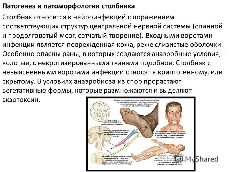 Сколько нельзя мочить столбняк. Столбняк симптомы столбняка. Основные клинические симптомы столбняка. Столбняк заболевание относится к. Ранними симптомами столбняка являются.