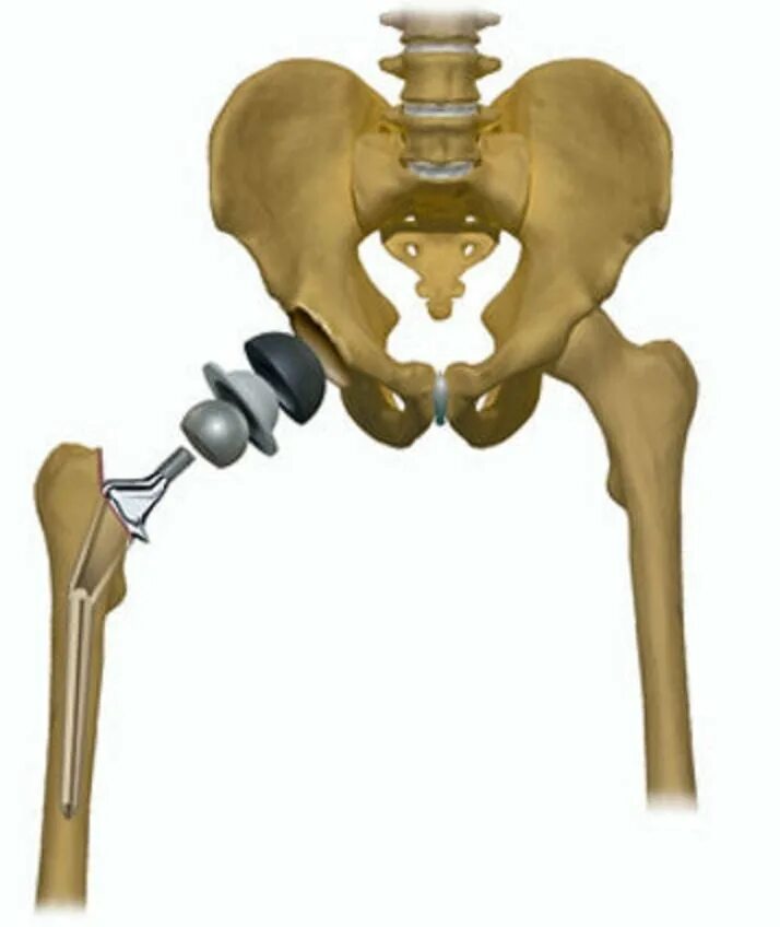 Медицина суставы тазобедренный. Коксартроз эндопротезирование тазобедренного сустава. Эндопротез шейки бедра. Коксартроз 3 степени тазобедренного. Коксартроз 4 степени тазобедренного сустава.